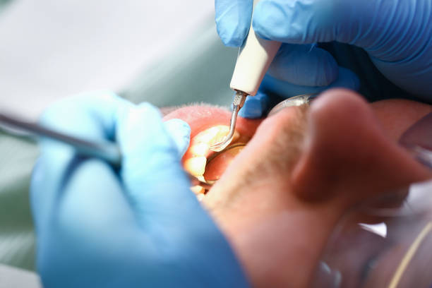 Best Emergency Wisdom Teeth Removal in Brookfield, NJ